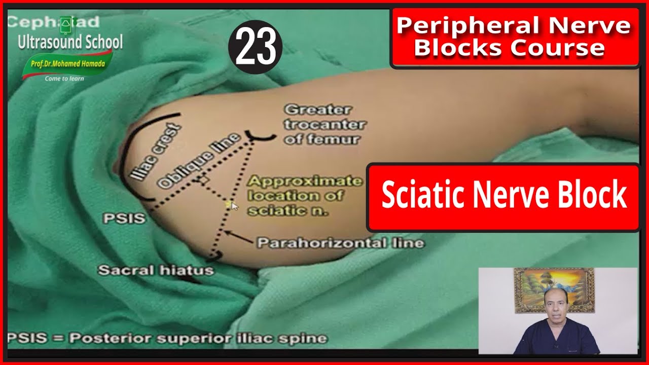 Sciatic Nerve Block ) |Mohamed Hamada|(23)