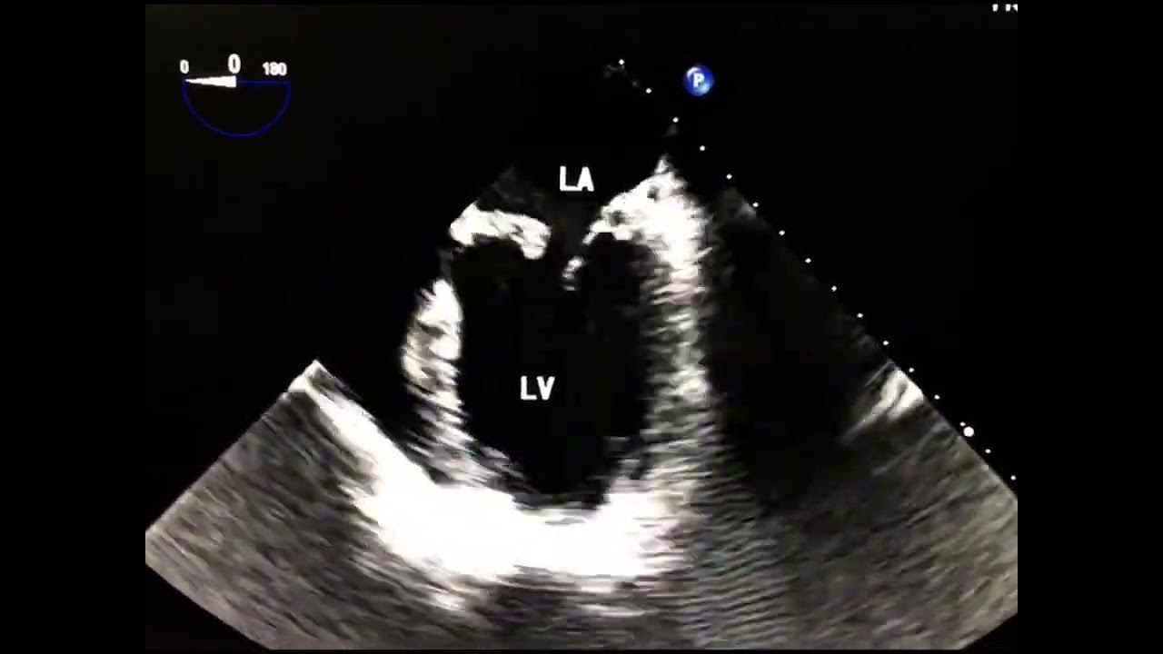 Mitral Valve Cleft: Not Rare, Not Limited to AV Canal Defects, and Why 3D TEE Is Essential