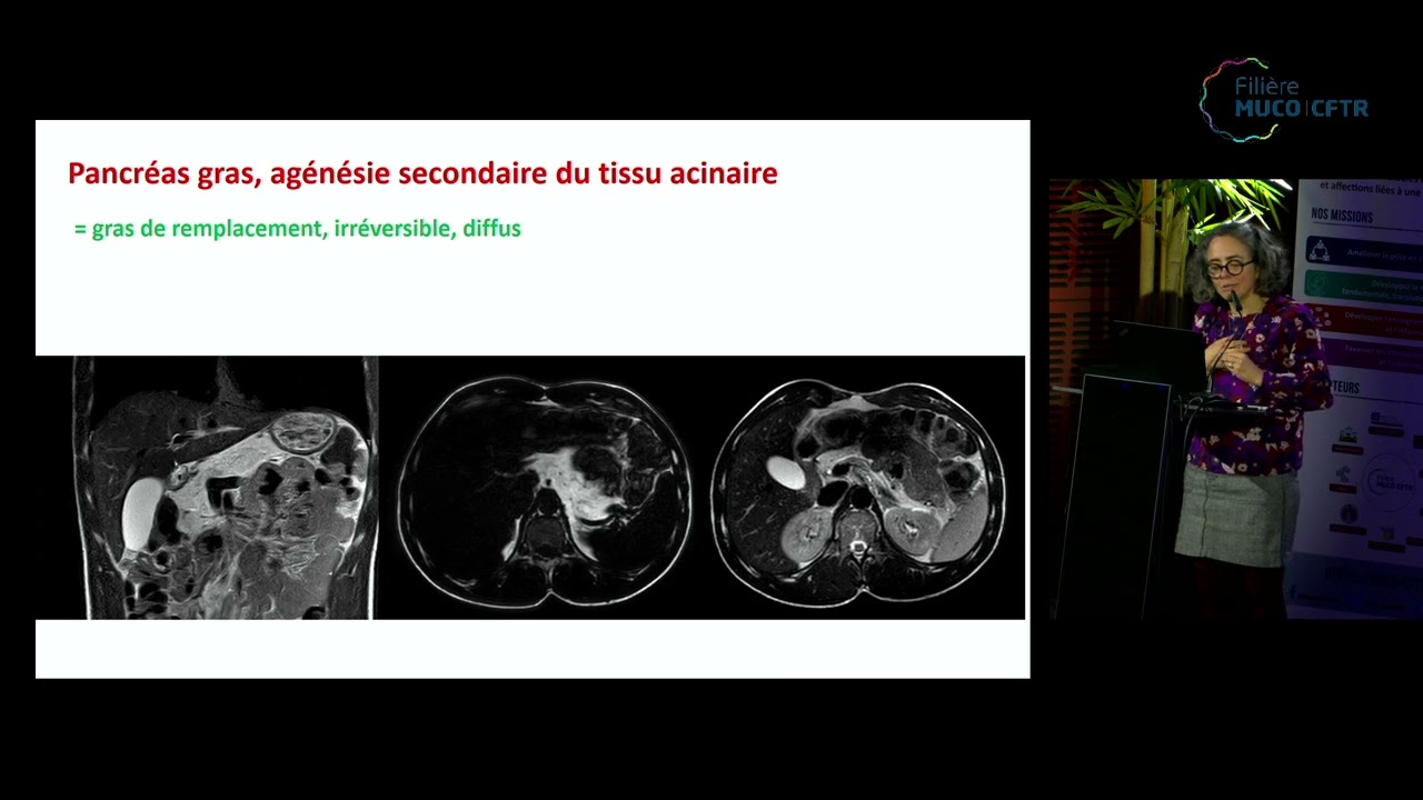Session Atteintes pancréatiques et gastro-intestinales - Atteinte pancréatique