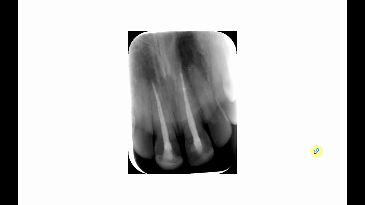 Elongation and foreshortening of images.