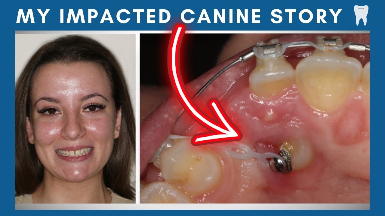 How My Impacted Canine affected My Braces Journey!
