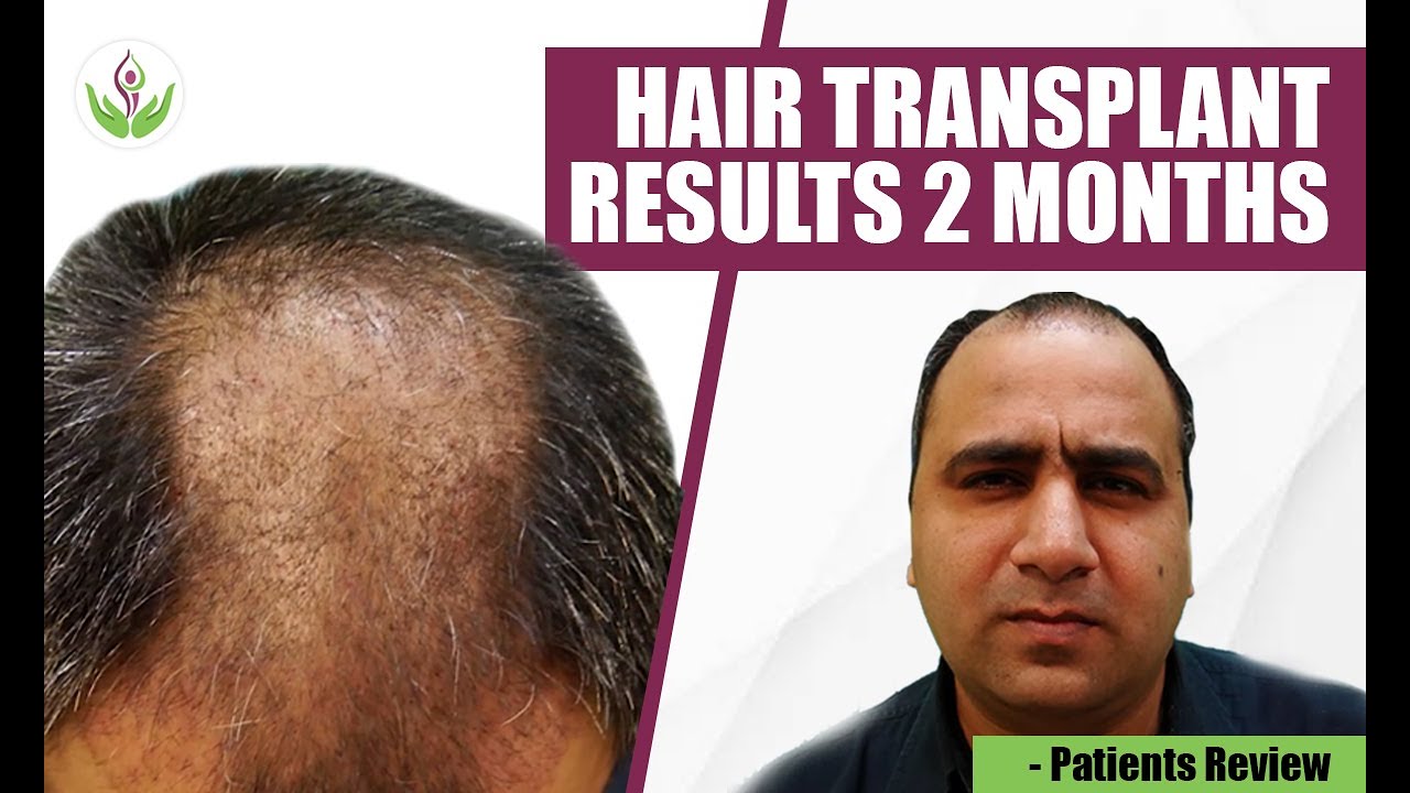 Hair Transplant Results After 2 Months - Patients Review | Care Well Medical Centre
