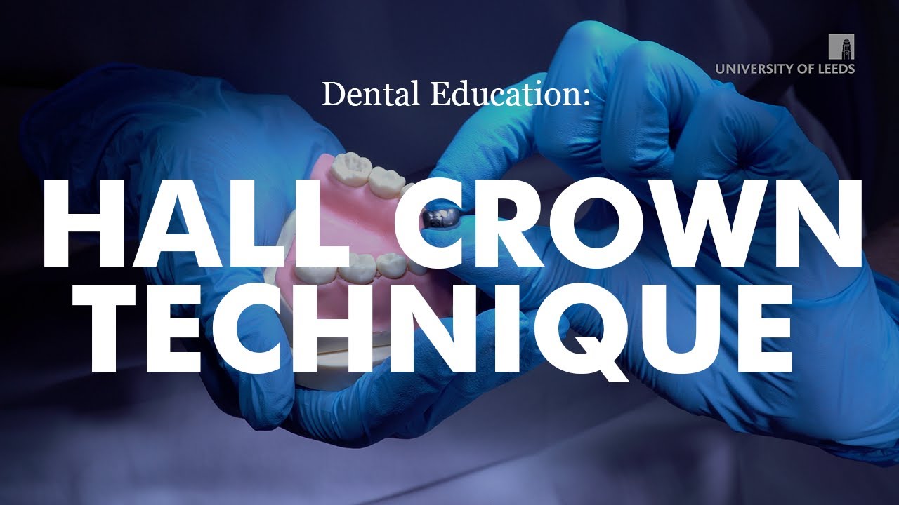 Метод установки коронок Dental Hall