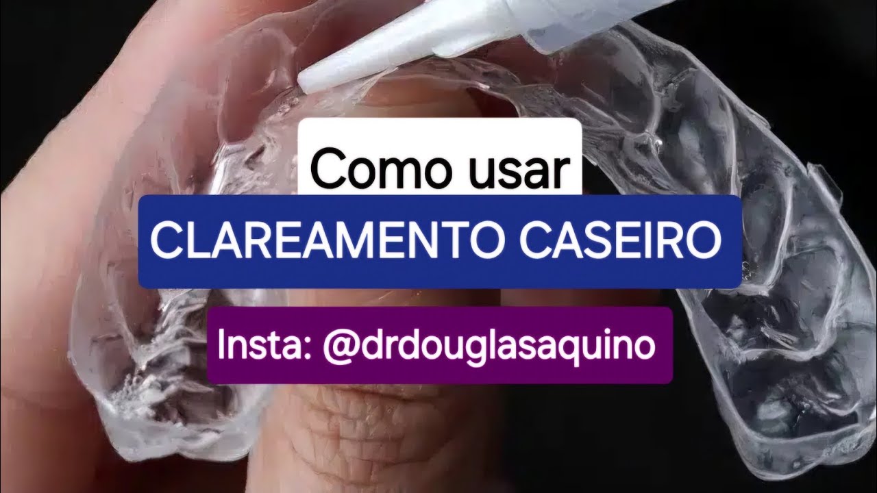 Insta: @drdouglasaquino -  Orienta&ccedil;&atilde;o sobre clareamento caseiro (de moldeira)