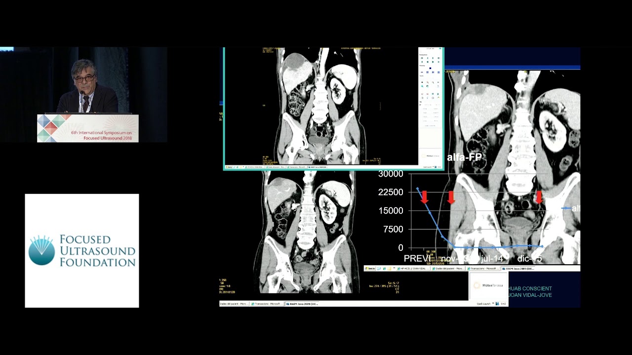 Joan Vidal Jove - FUS with ultrasound guidance in liver cancer (2018)