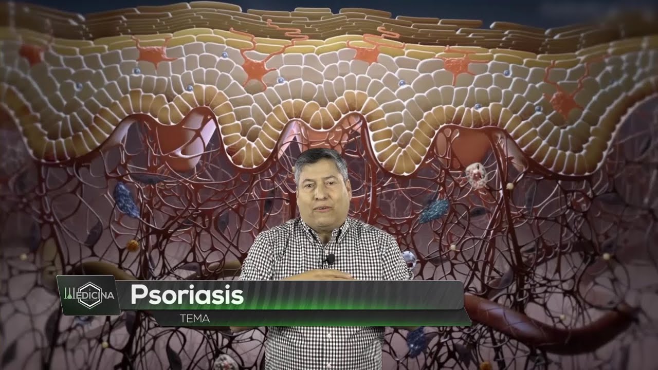 Medicina para todos: Psoriasis