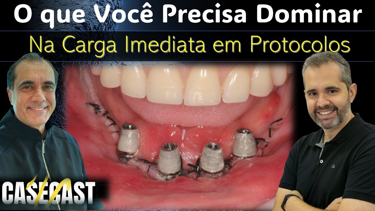 O que Você Precisa DOMINAR para Fazer Protocolo em CARGA IMEDIATA? #protesesobreimplante