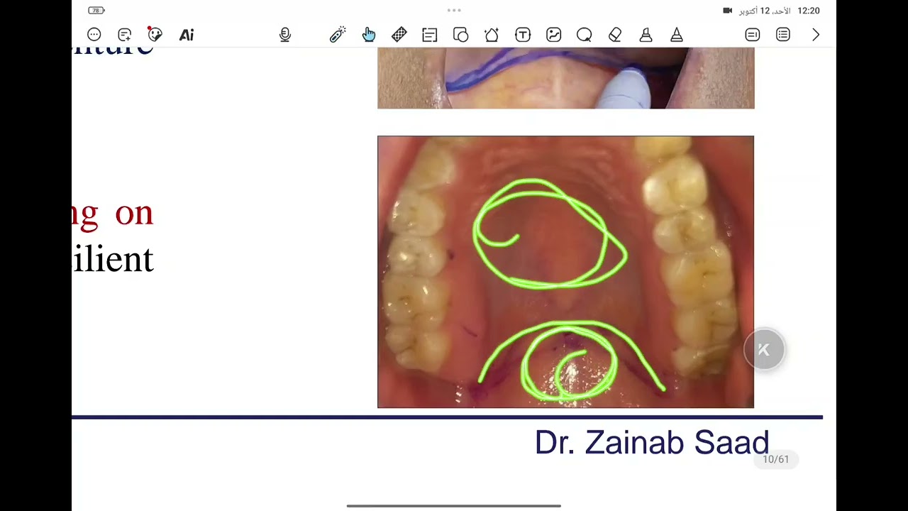 Posterior palatal seal area prosthodontics 5th 
