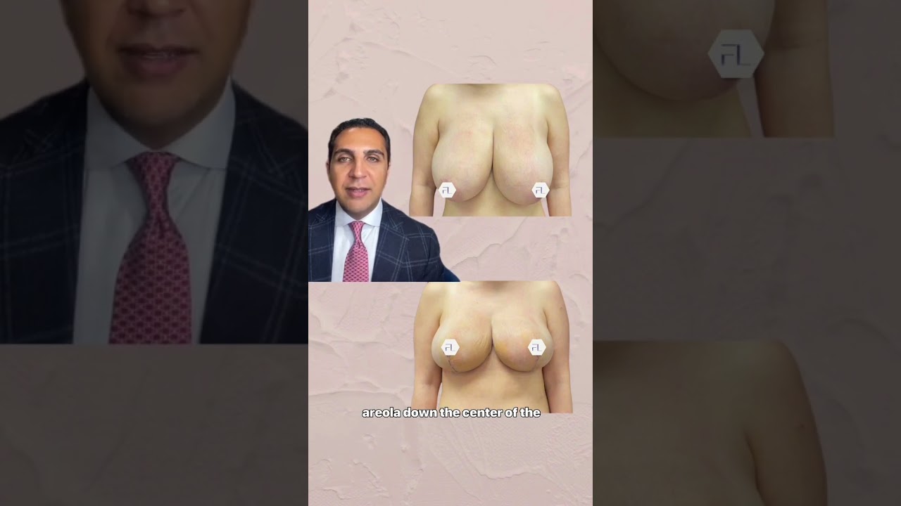 Breast Reduction - Before & After