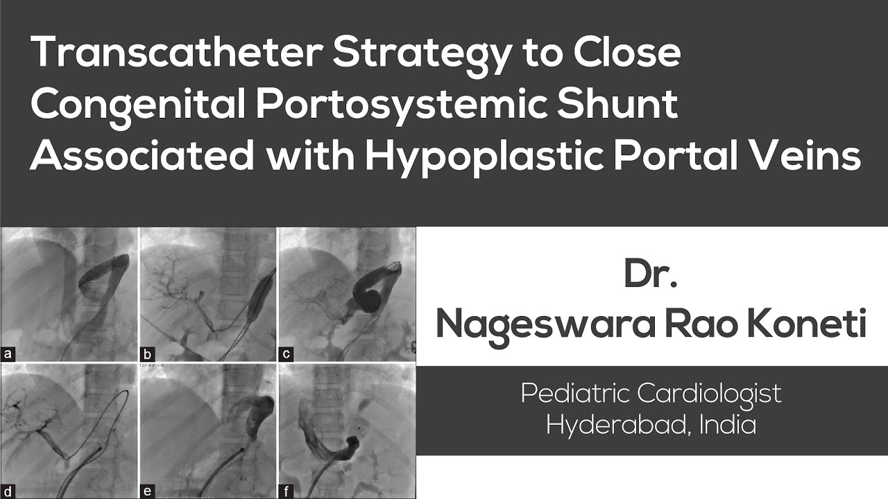Transcatheter Strategy to Close Congenital Portosystemic Shunt Associated with Hypoplastic Portal