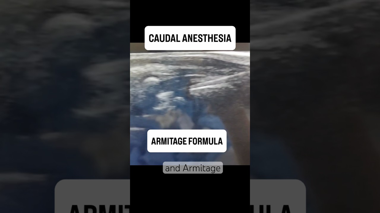 Caudal Block & Armitage Formula #anesthesia #medicine #doctor