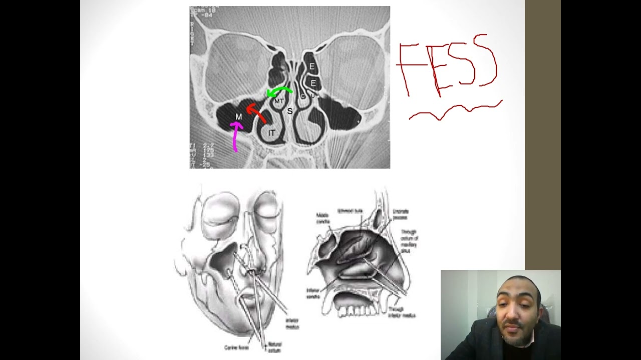 Disease 3   sinusitis   comp / dr.ahmed hassan sweed