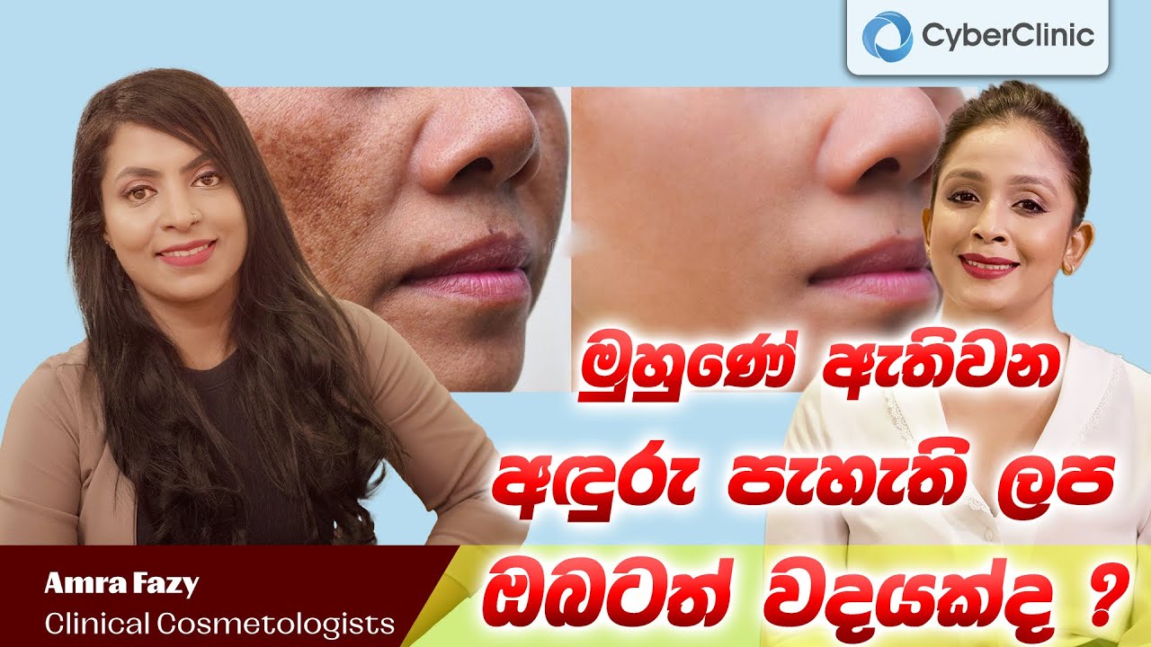 මුහුණේ ඇතිවන අඳුරු පැහැති ලප ඔබටත් වදයක්ද ?