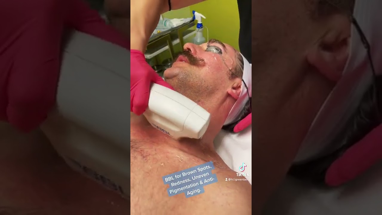 BBL Treatment ⚡️ at Las Vegas Dermatology
