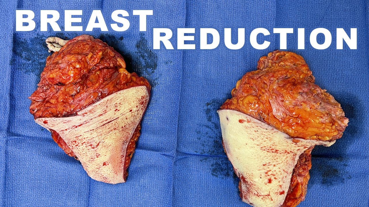 Breast Reduction-&nbsp;Dr. Paul Ruff | West End Plastic Surgery