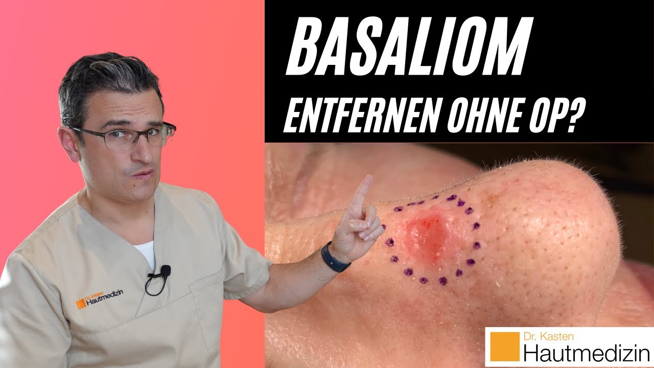 Basaliom entfernen ohne OP? | Dr. Kasten Hautmedizin in Mainz