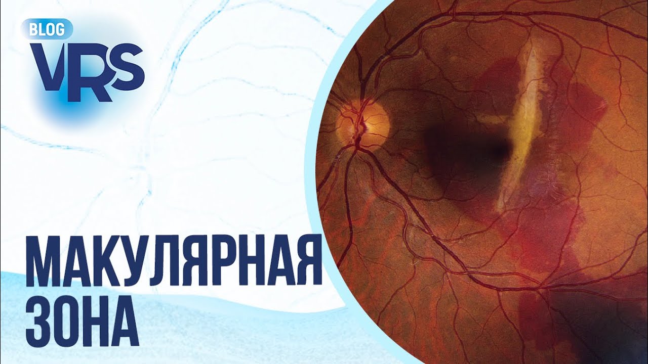 Травма глаза / Макулярная зона