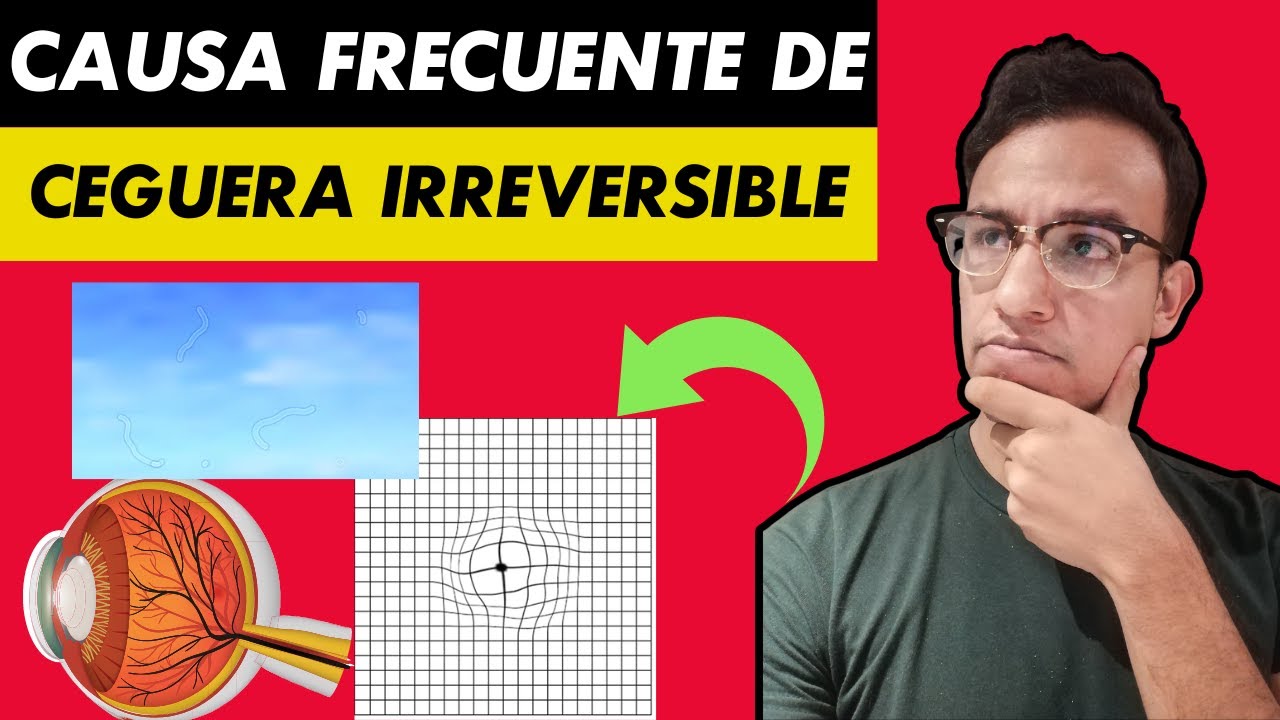 DEGENERACIÓN MACULAR - primera causa de ceguera NO REVERSIBLE