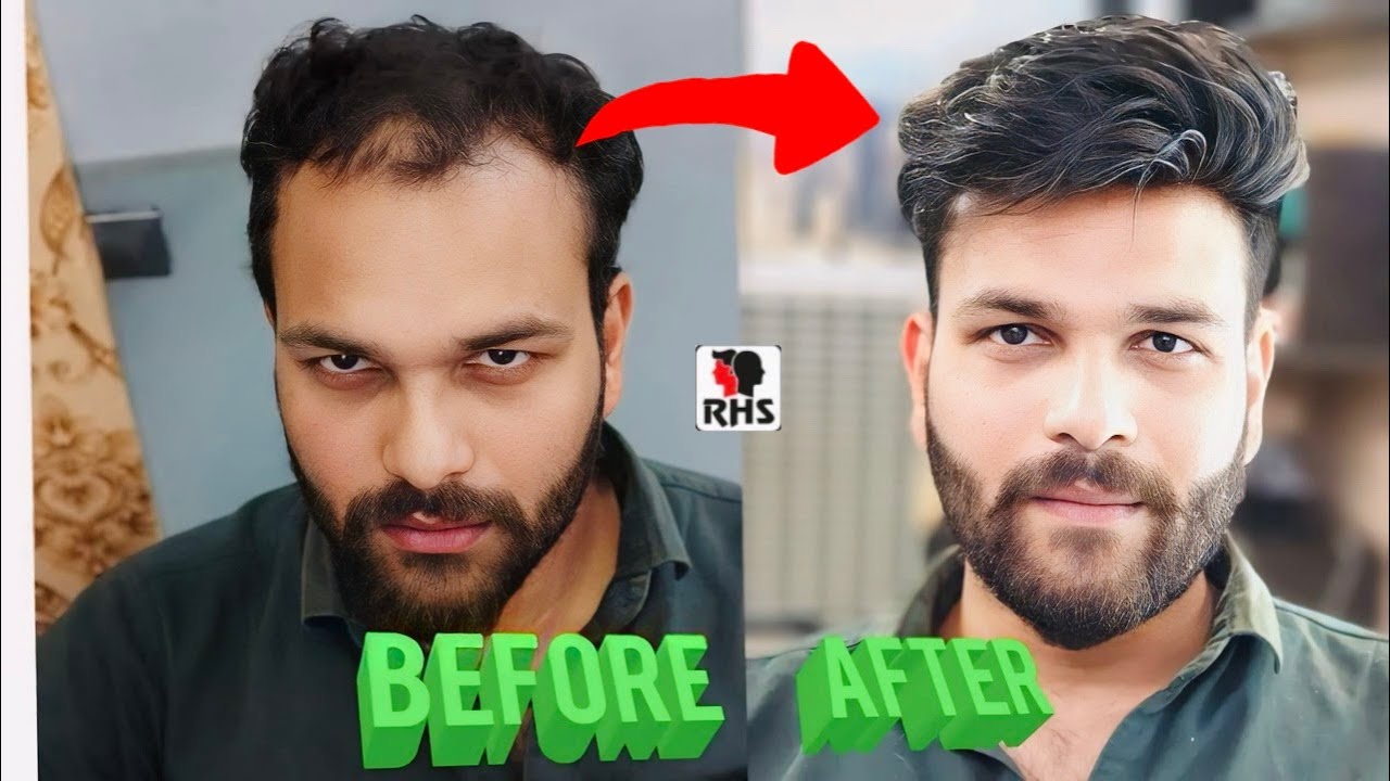 Hair Patch For Men | Rizy Hair Solution | Natural Hairline Patch | Call Us 9599858612