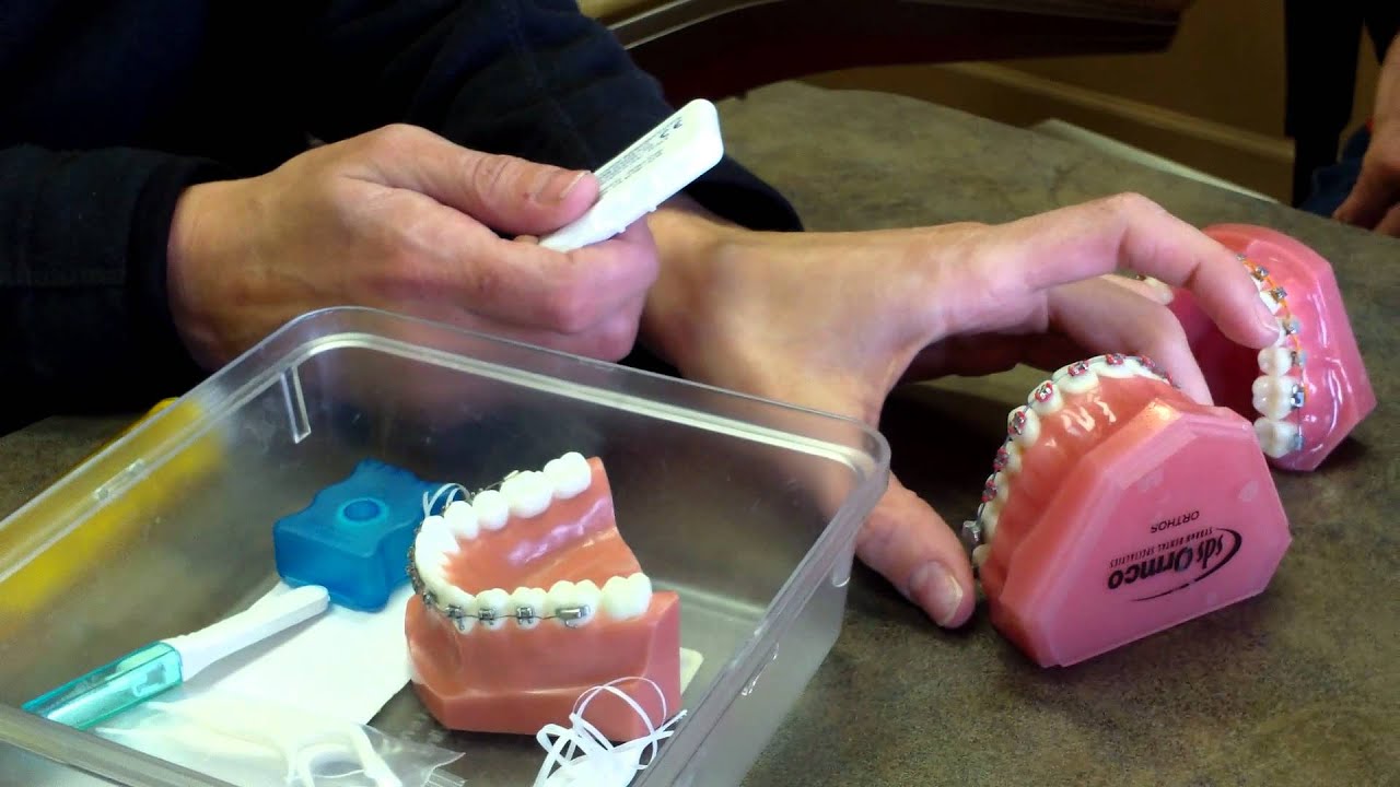 Cleaning Braces by Orthodontist Dr Don Wilson Novato CA