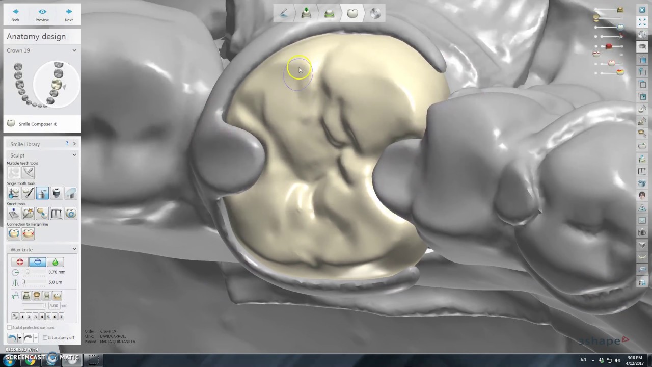3shape design retrofit crown to partial clasp with rests