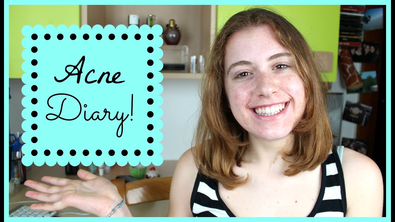 Acne Diary: STA FUNZIONANDO!