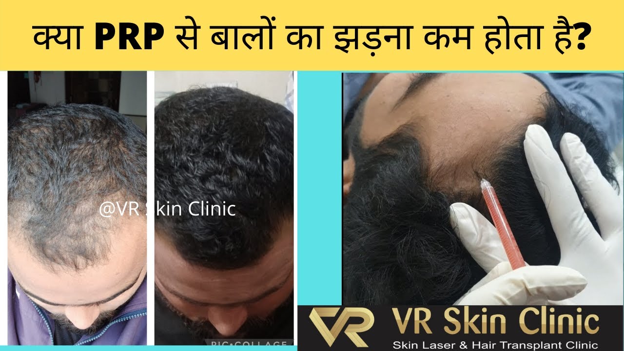 PRP Therapy for Hair Growth (Hindi) | VR Skin Clinic | Dr Vineet Kumar | Bikaner | Hair treatment