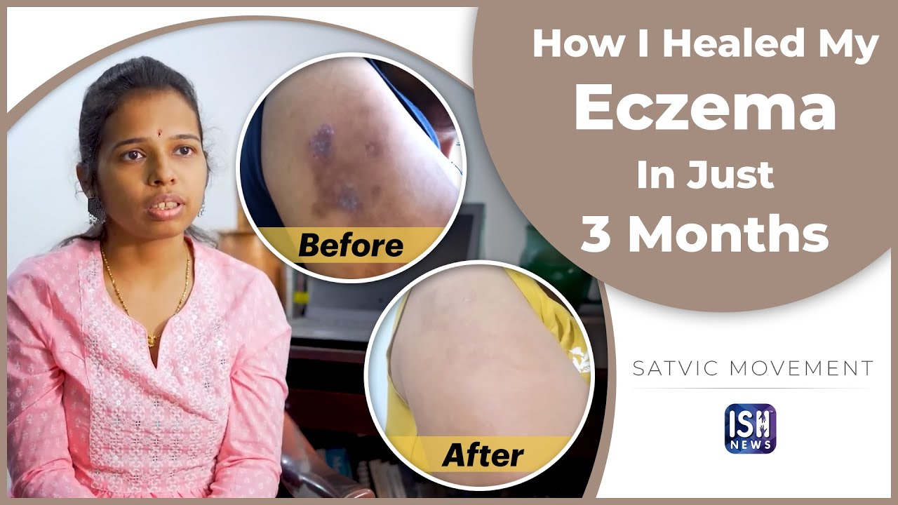 How I Healed My Eczema In Just 3 Months | ISH News