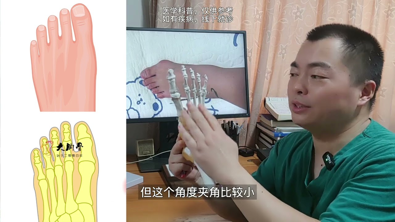 拇囊炎的原因是什么？拇外翻疼痛怎么治疗 Bunion