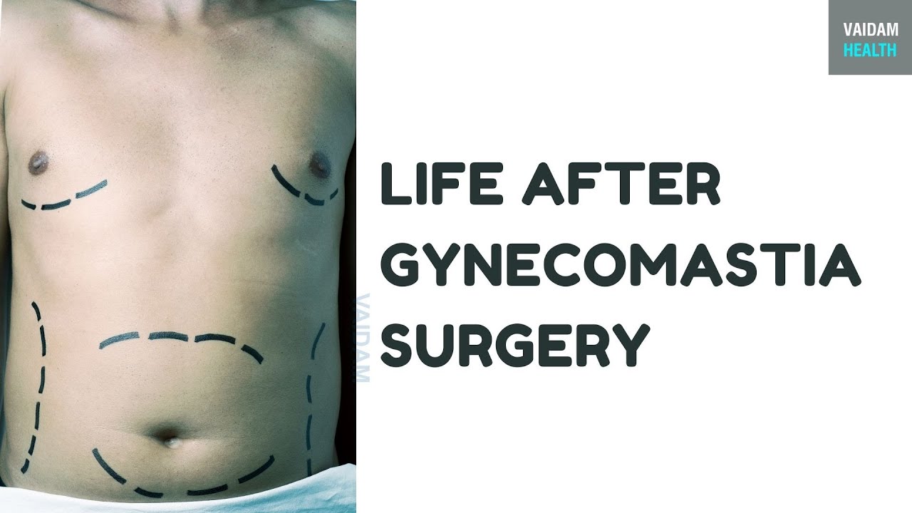 Life after Gynecomastia Surgery