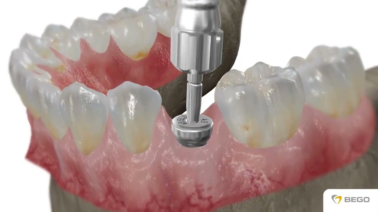 BEGO Semados® SC SCX Implantate   implants