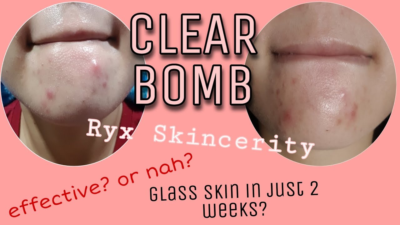 RYXSKINCERITY NEW CLEAR BOMB HONEST REVIEW
