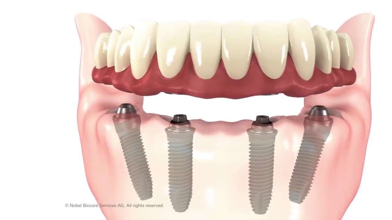 All-on-4&reg; Dental Implants Fort Lauderdale, FL | Dr. Sawan Malik