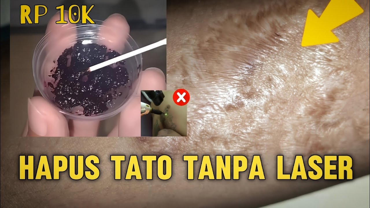 cara menghapus tato tanpa laser