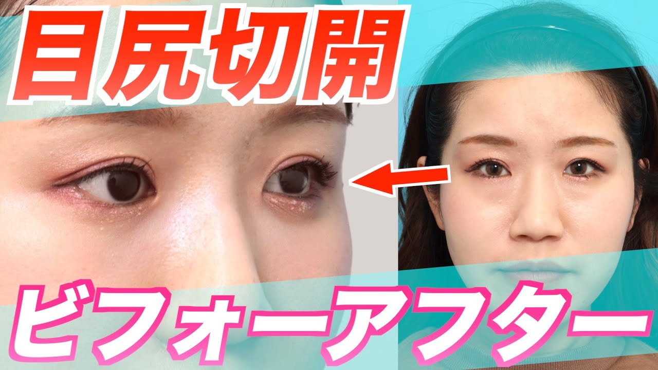 【整形】目尻切開のカウンセリング→ダウンタイム→ビフォーアフターまでを公開します。