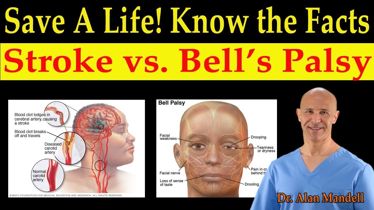 Save a Life!  Know the Facts of Stroke vs. Bell's Palsy (Natural Remedies)  - Dr. Alan Mandell, D.C.