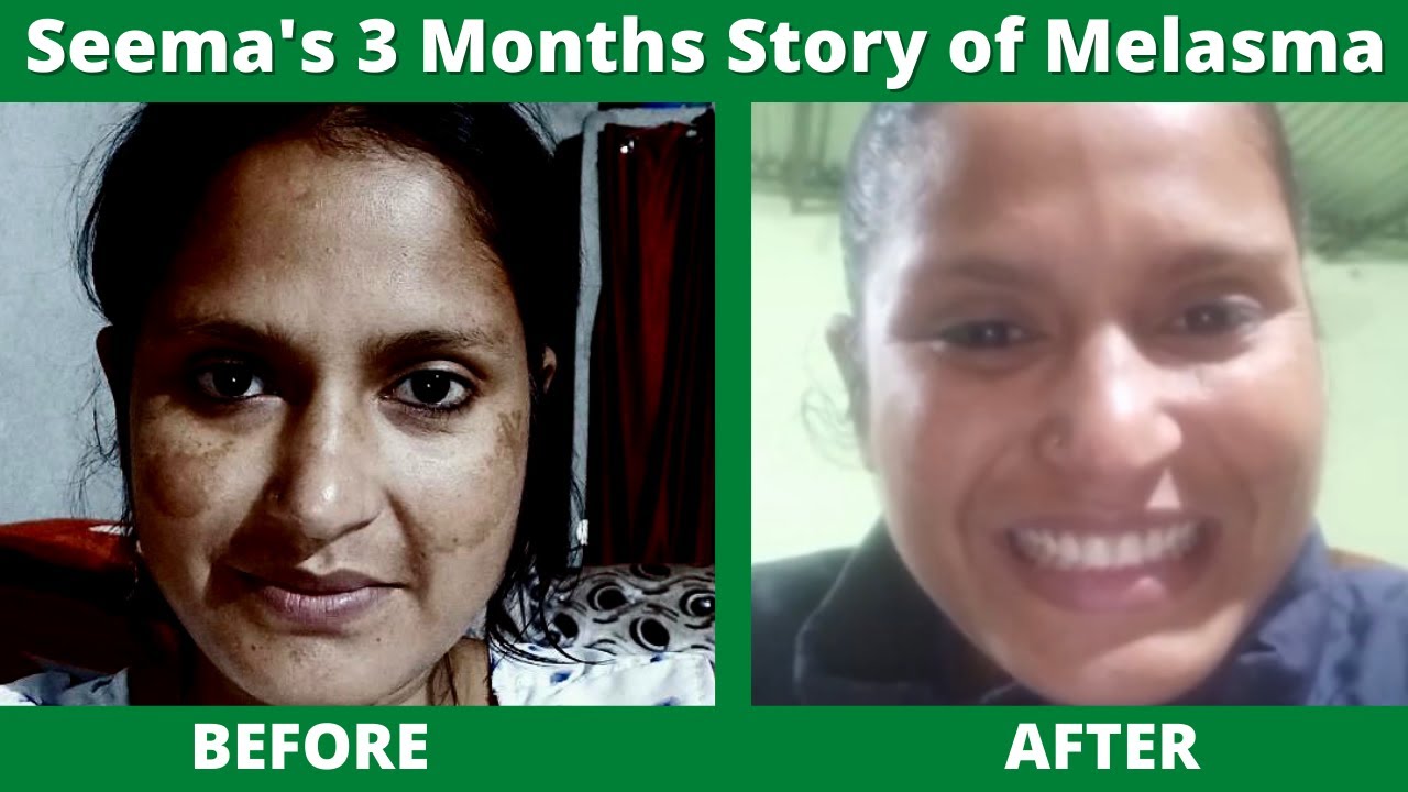 Seema's 3 Months Story of Melasma/Pigmentation. 3 महीनों में मेरी झाँइयाँ कम हो गयी I