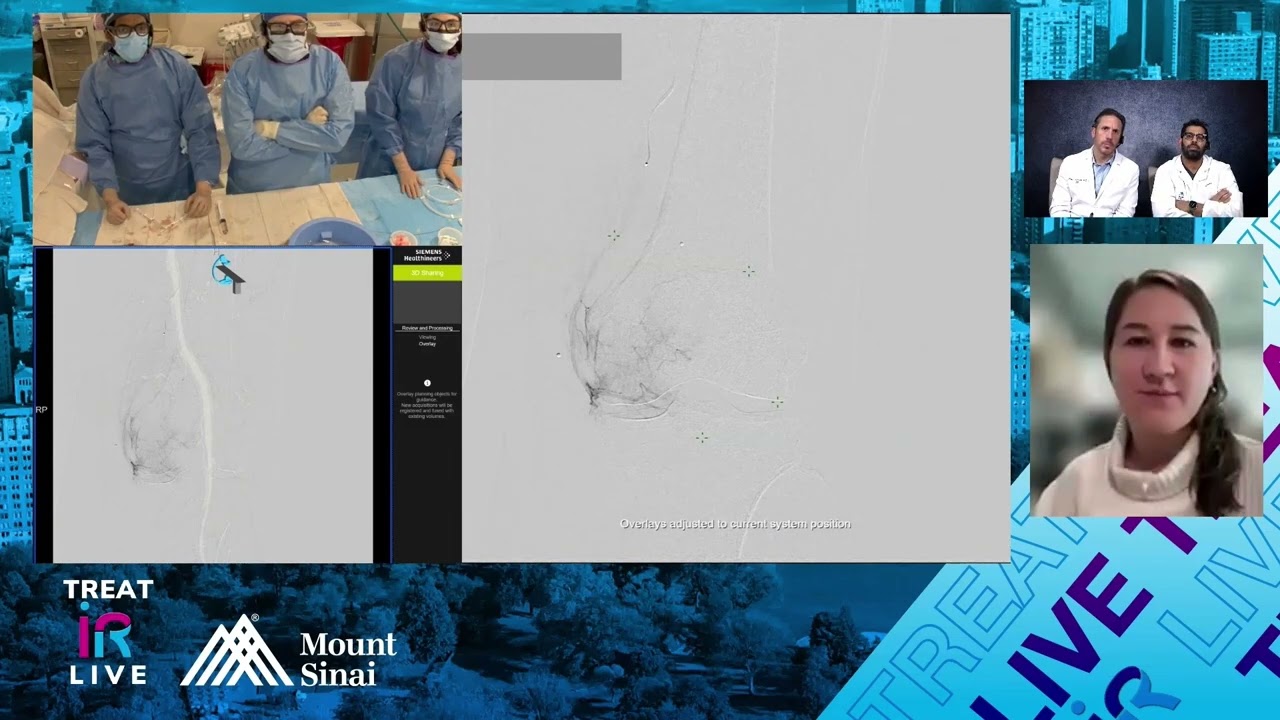 Transfemoral Genicular Artery Embolization (GAE) for Knee Osteoarthritis