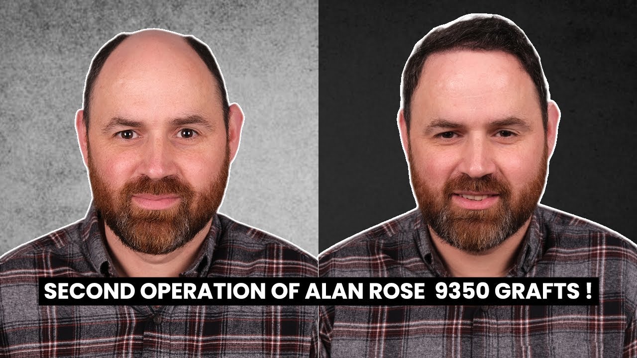 SECOND OPERATION OF ALAN ROSE - 9350 GRAFTS ! | This time for the crown coverage!