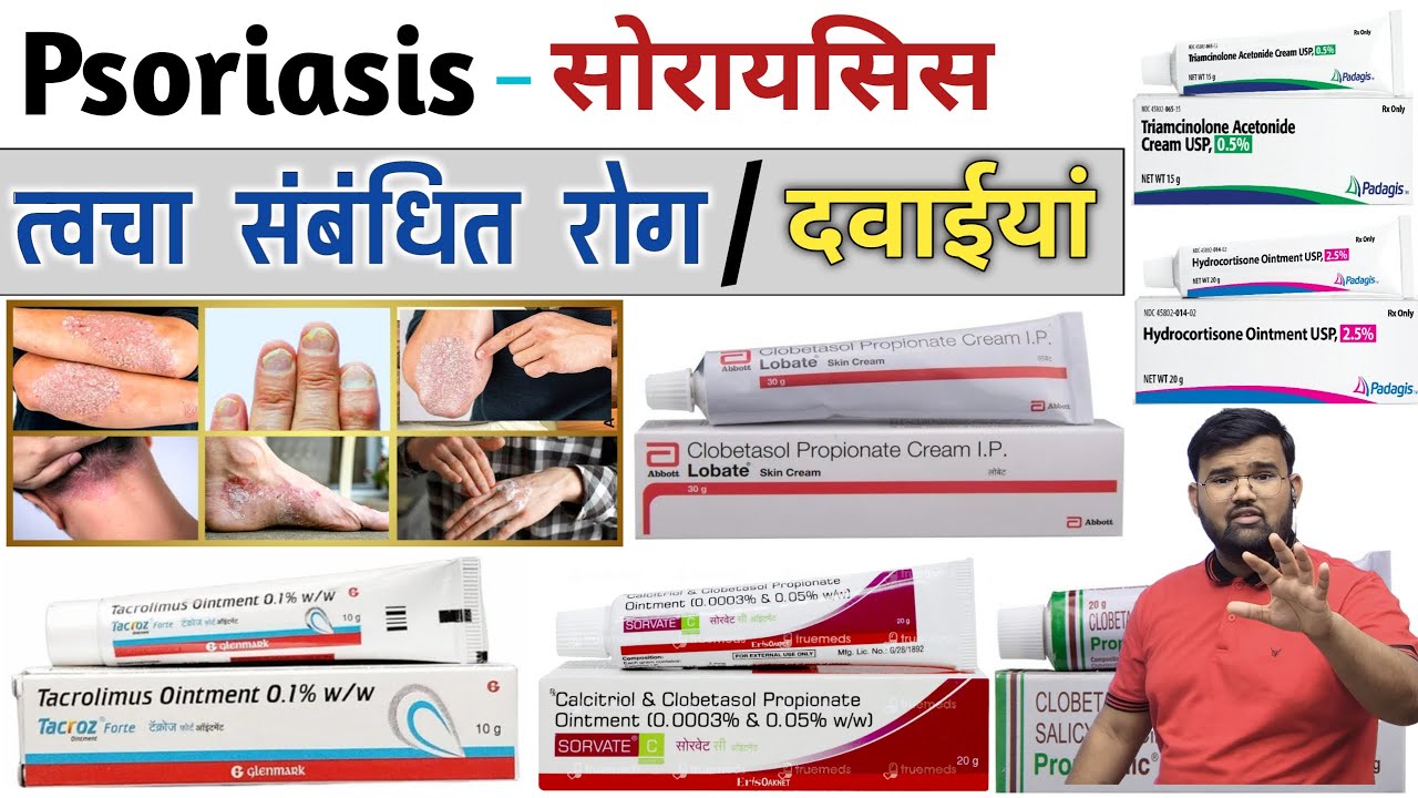 Psoriasis | त्वचा संबंधित रोग | Skin Disease | Treatment | Medicine | Doctor | Pharmacy | MBBS