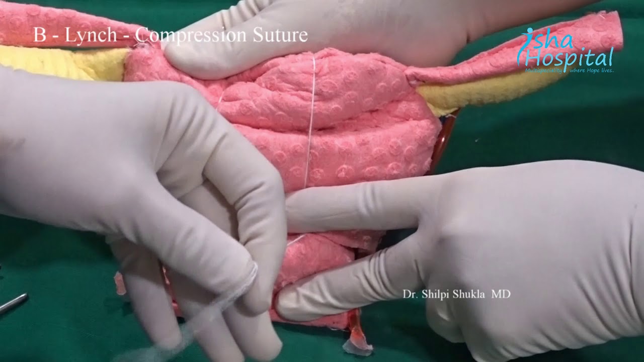 Uterine compression sutures