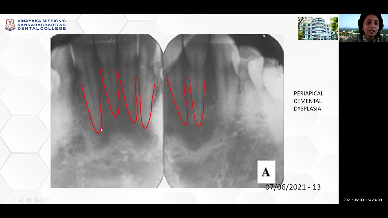 Dr  Saramma Mathew Fenn   Periapical Radiolucencies
