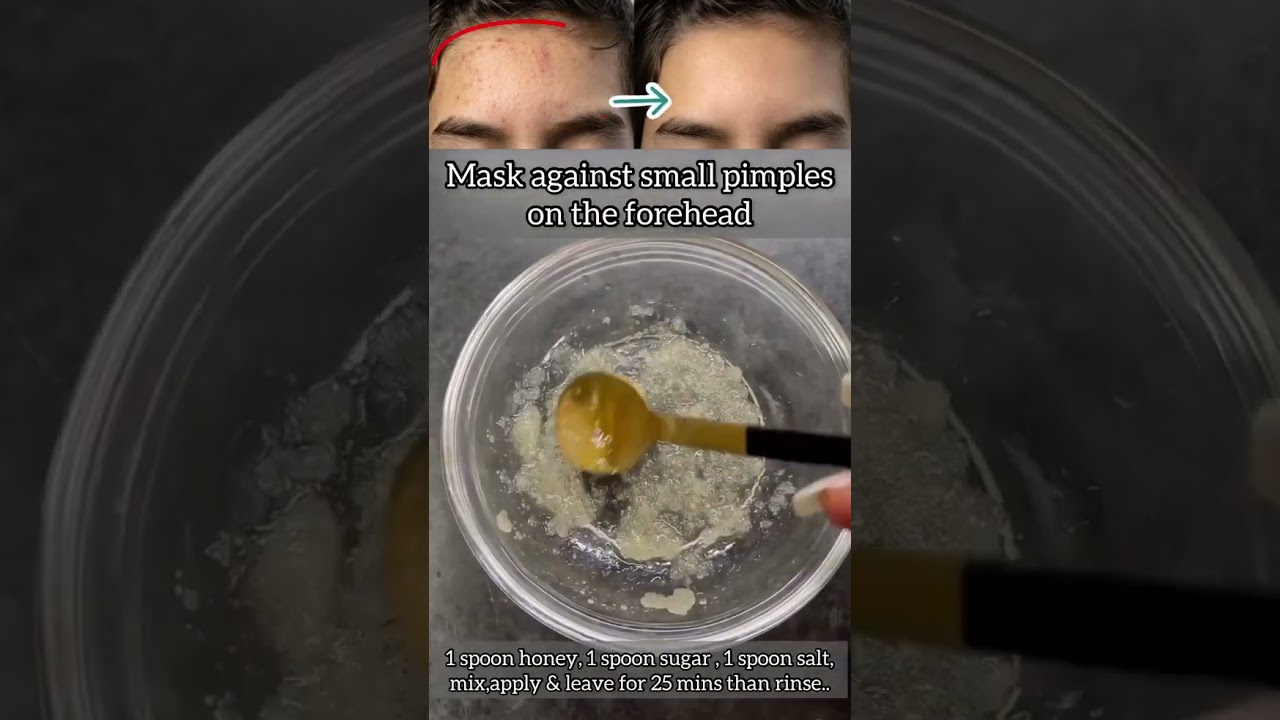 forehead pimples removing tip