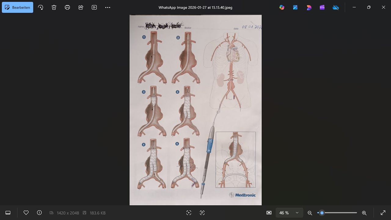 🤔 Mein Aneurysma der BAUCH-AORTA, mit 5,8 cm DURCHMESSER❗ wat nu ❓TEIL 2