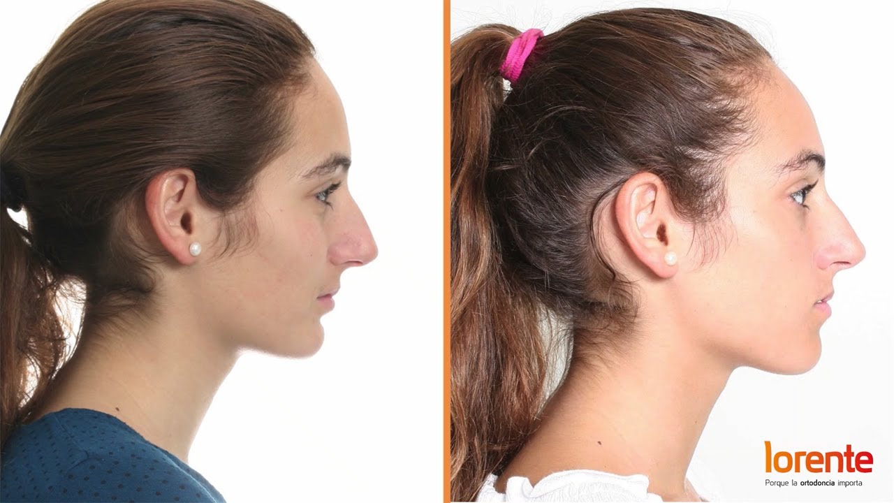 Experiencia real: avance mandibular y fenestración en Lorente Ortodoncia