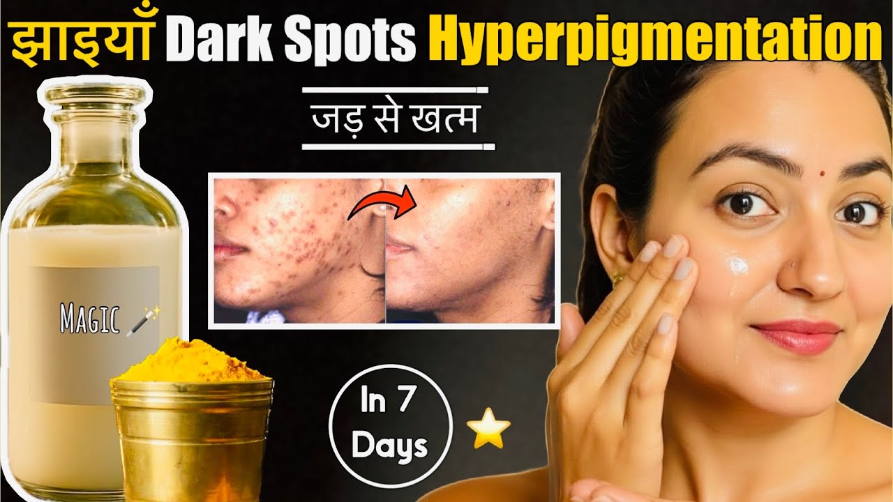 7 Days Skin Challenge : Remove Dark Spots, Acne Scars, Pimple Marks & Pigmentation | 100% Results💕