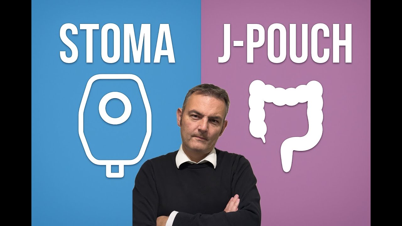 J-Pouch vs Ostomy (Stoma): My Honest Experience Living With Both