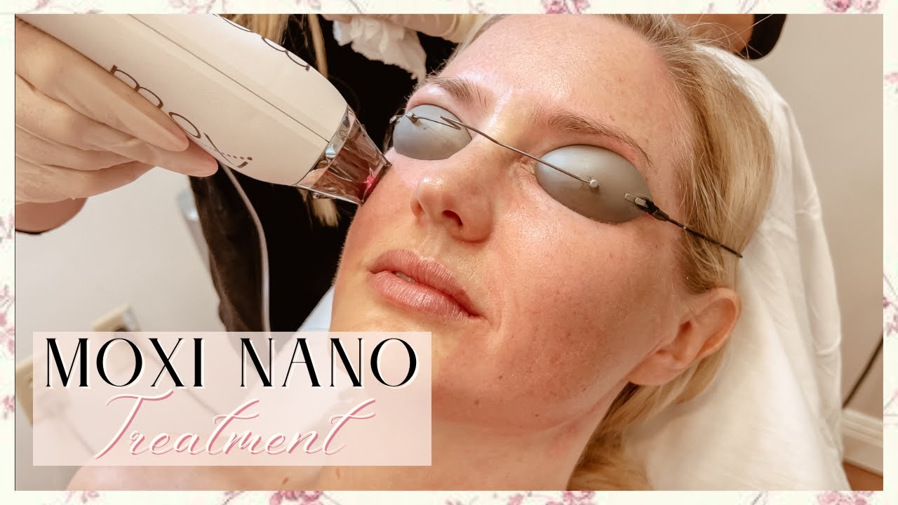 MOXI NANO Laser Treatment | Skin Before & After | Healing Process