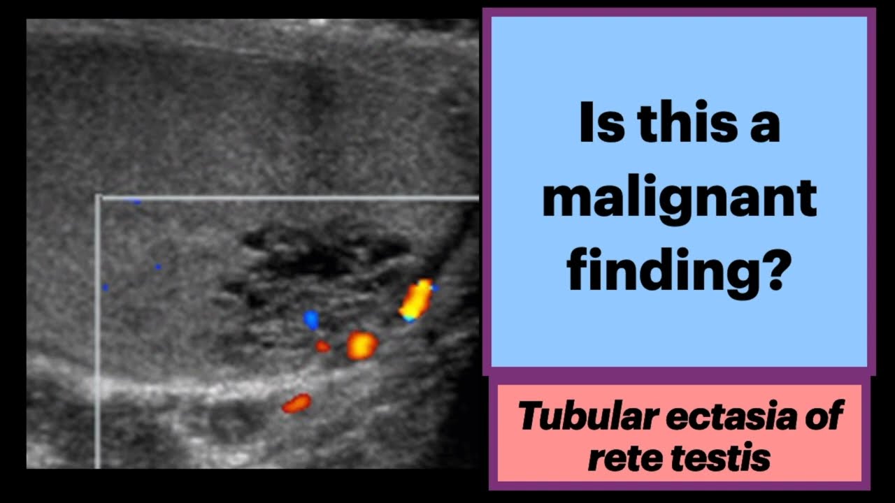 Tubular Ectasia of the Rete Testis #Radiology #Urology #Ultrasound