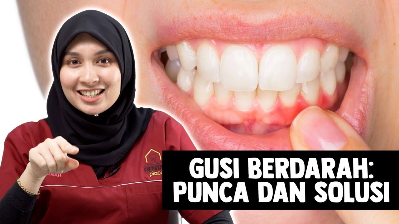 Gusi Berdarah: Punca dan Solusi